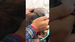 SOLUTION HAIR PATCH ONLY RS 7000 BONDING FIXING TAPING clipping hairsolutions hairsolution [upl. by Bertero865]