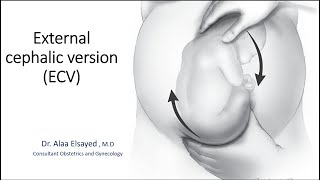 External cephalic version ECV [upl. by Jonette]