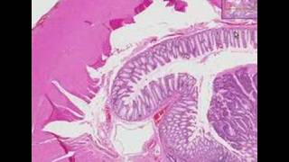 Histopathology Colon Adenocarcinoma [upl. by Cindy]