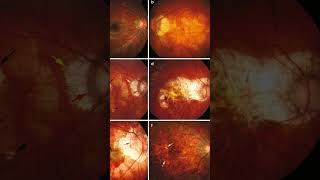 myopia pathological [upl. by Brock]