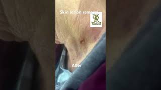 Skin lesion removal [upl. by Odrawde]