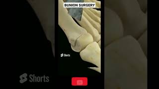 BUNION bunion treatment buniontoe bunion [upl. by Esya131]