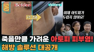 Full 죽을만큼 가려운 아토피 피부염 해방 솔루션 대공개ㅣ귀하신 몸ㅣ80화 나의 지긋지긋한 아토피 해방일지 [upl. by Hafinah187]