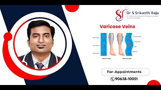 Varicose Veins  All you need to Know  DrSrikanth Raju  Vascular Surgeon  Hyderabad [upl. by Halimeda728]