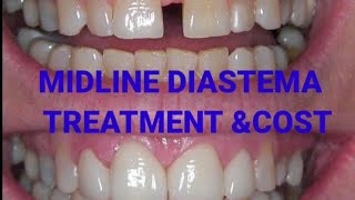 what are the options for management of midline diastemamidline diastema closureدانتوں کے گیپ بھرے [upl. by Carmine]