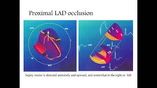 Localizing the culprit artery blockage in patients experiencing a STEMI ECG analysis  MI [upl. by Jala]