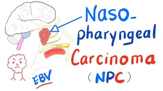 Nasopharyngeal Carcinoma NPC Location Risk Factors Clinical Picture Diagnosisamp Management [upl. by Sucramel]