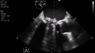 severe prosthetic mitral valve endocarditis with partial valve dehiscence [upl. by Oniratac708]