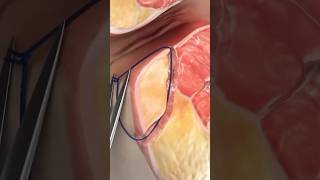 Laser Closure of Fistula Tract FiLaC Video credit SurgMedia Youtubecom [upl. by Il]