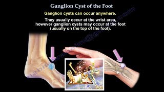 Ganglion Cyst Of The Foot  Everything You Need To Know  Dr Nabil Ebraheim [upl. by Enelrahs742]