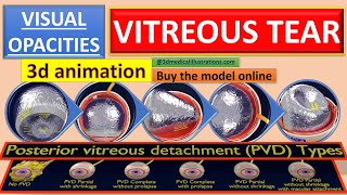 posterior vitreous detachment pvd I eye floaters retinal tears and retinal detachments I [upl. by Begga132]