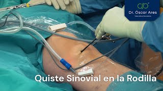 Quiste sinovial en la rodilla  Dr Oscar Ares [upl. by Ginevra75]