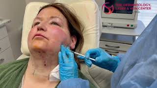 Masseter Botox Injections Reshape Your Jawline and Relieve Jaw Tension  Dr Shalini Gupta [upl. by Felecia987]