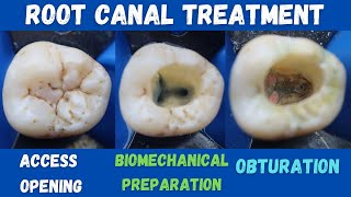 Root Canal Treatment 🔵 Mandibular First Permanent Molar 🟡 access opening ⚪️ BMP 🟣 obturation 🔴 [upl. by Llerehc]