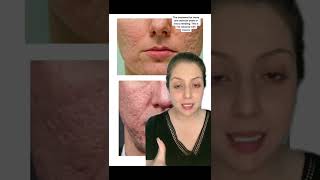 Treatment for pitted acne scars [upl. by Ihtak499]