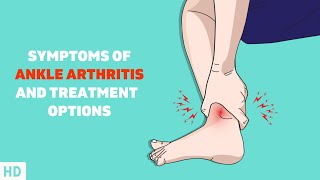 Dont Ignore Your Ankle Pain Understanding Ankle Arthritis [upl. by Aleina]