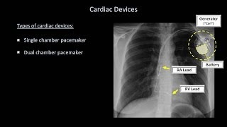 How to Interpret a Chest XRay Lesson 9  Atelectasis Lines Tubes Devices and Surgeries [upl. by Coad523]