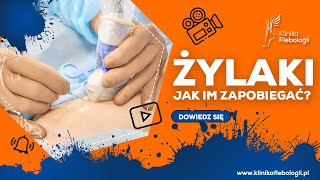 ŻYLAKI  jak im zapobiegać [upl. by Dot642]