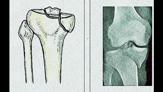 Anterior Midline Approach for Proximal Tibia Fracture  Dr Sanjay Sarvaiya [upl. by Annirak]