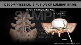 Decompression amp Fusion of Lumbar Spine [upl. by Staford245]