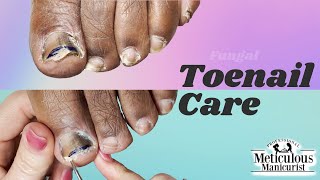 Toenail Fungus Care at Home [upl. by Aikan]