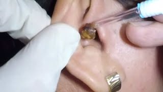 Womans Massive Earwax Removal in Both Ears [upl. by Shutz799]