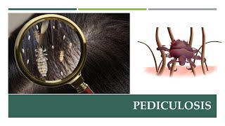 Lice Infestation Pediculosis Lecture [upl. by Nylasej23]