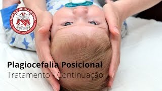 Plagiocefalia Posicional  TRATAMENTO CONTINUAÇÃO  Dr Diogo Neurocirurgião [upl. by Ssilem728]