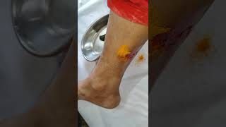 A patient having Varicose Veins from last 10 years undergoing treatment ayurveda jalauka chikitsa [upl. by Yazbak]