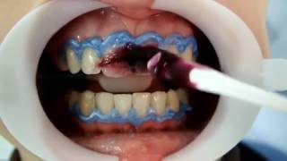 Using FGM Whiteness HP Maxx For In Office Bleaching Tooth Whitening [upl. by Abernathy]