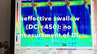 Analysis of Esophageal High Resolution Manometry ESNM Teaching Video [upl. by Sisxela]