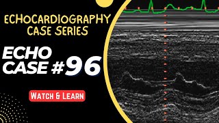 ECHO CASE 96  Echocardiography for Beginners  M Mode Echocardiogram [upl. by Hollinger526]