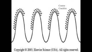 coarse crackles [upl. by Ertha]