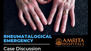 Case Discussion  Rheumatological Emergency  Rheumatoid Arthritis [upl. by Chadd338]