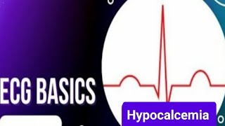 ECG Basics  ECG changes in  Hypocalcemia  causes and symptoms of Hypocalcemia [upl. by Wanyen]