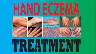 DyshidrosisDyshidrotic eczemaHand eczemaPompholyx treatment [upl. by Jean762]