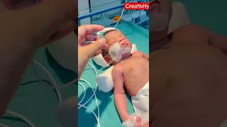 Newborn baby orogastric Tube Feeding video nicu medical viral [upl. by Midian]