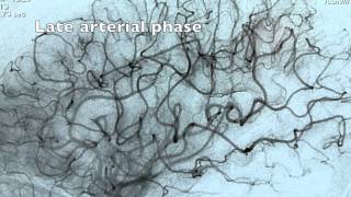 Cerebral angiogram [upl. by Nuj151]