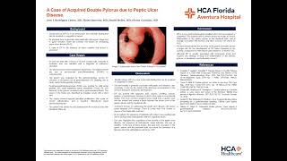 A Case of Acquired Double Pylorus due to Peptic Ulcer Disease [upl. by Enileoj881]