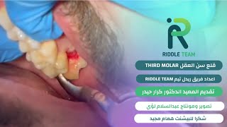 قلع ضرس العقل العلوي  Extraction of upper wisdom teeth [upl. by Shantee]