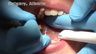 Laser Posterior Tongue Tie Revision in Calgary Alberta [upl. by Aromas]