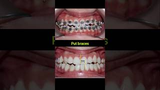 Braces Fix Misaligned Jaw braces orthodontist dentist bracesoff [upl. by Agace]