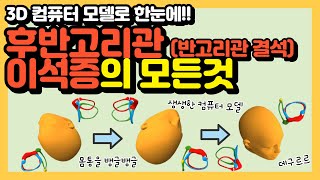 후반고리관 반고리관 결석 이석증의 모든 것 3D 컴퓨터 모델로 한눈에 [upl. by Ixela]