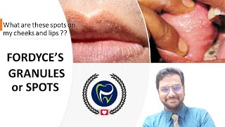 Dr Rudra Mohan  Fordcyes GranulesSpots What are these granulesspots on my cheek [upl. by Romain]