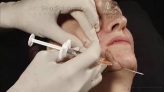 Combined therapies for treating the aging face with Pluryal hyaluronic acid filler [upl. by Maggee823]