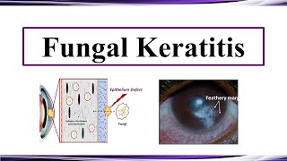 Fungal Keratitis [upl. by Bashuk600]