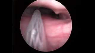 Stent and tracheoscopy in dog [upl. by Thirza110]