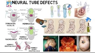 INSTANT NEURO  Neural Tube Defects [upl. by Aryahay854]