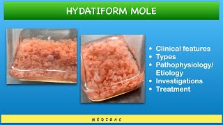 Hydatidiform Mole  Clinical features  Types  Pathophysiology  Investigations  Treatment [upl. by Vedis]