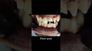 Post And Core Build Up In Patient  dentalprocedures postcore dentalcare aptedentalcare short [upl. by Ahsiatal]